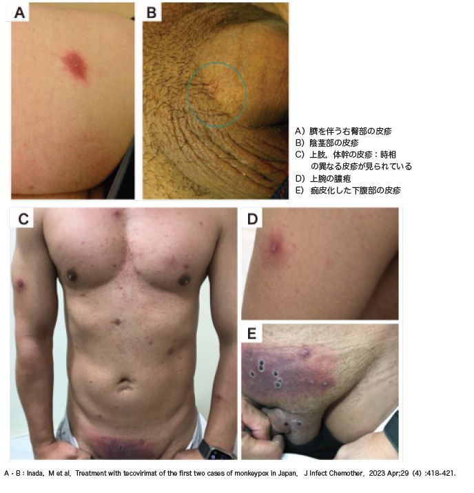 図2-1 エムポックスの皮疹