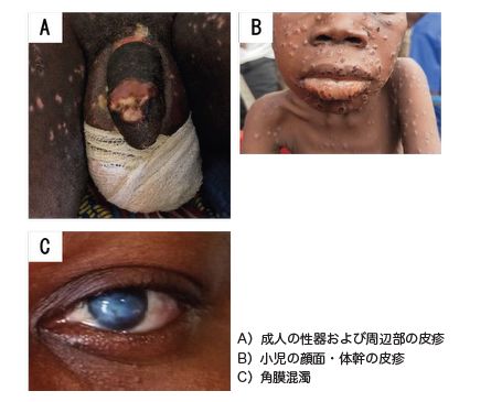 図2-2 クレードIa エムポックスの病変